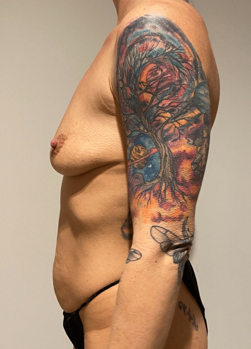 Mommy Makeover Before & After Gallery - Patient 413984 - Image 7