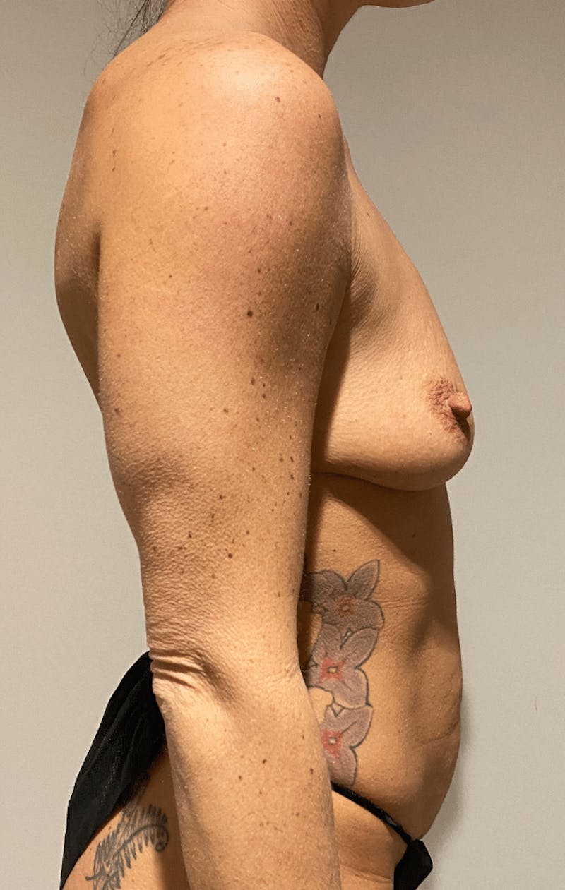 Mommy Makeover Before & After Gallery - Patient 413984 - Image 11