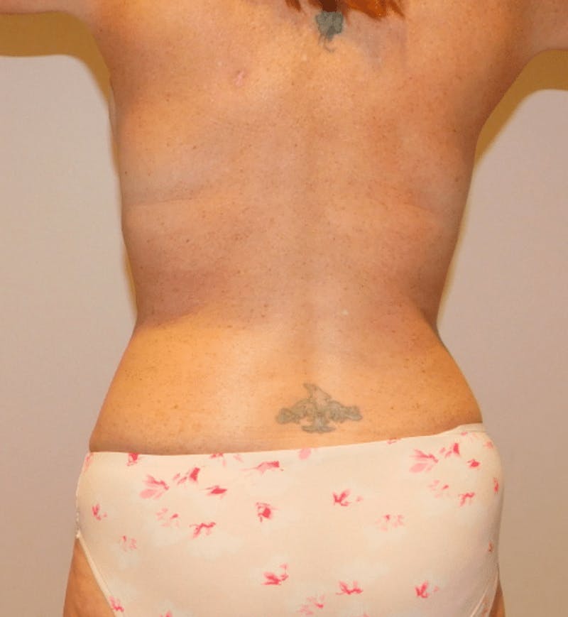 Mommy Makeover Before & After Gallery - Patient 806592 - Image 10