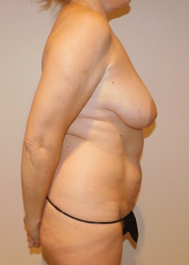 Mommy Makeover Before & After Gallery - Patient 169113 - Image 7
