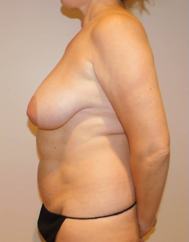 Mommy Makeover Before & After Gallery - Patient 169113 - Image 11