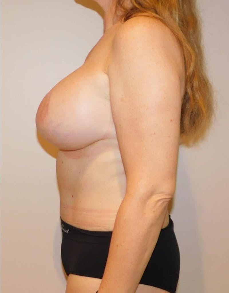 Mommy Makeover Before & After Gallery - Patient 169113 - Image 12