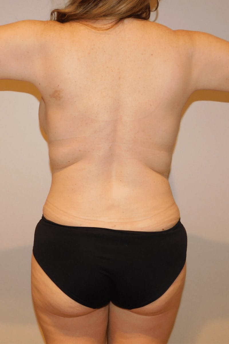 Mommy Makeover Before & After Gallery - Patient 169113 - Image 14