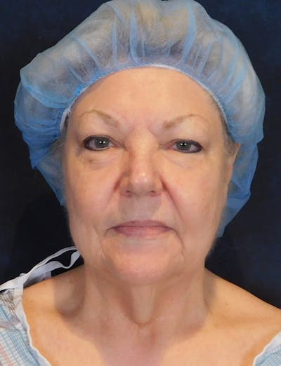 Facelift & Neck Lift Before & After Gallery - Patient 312535 - Image 1