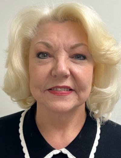 Facelift & Neck Lift Before & After Gallery - Patient 312535 - Image 2