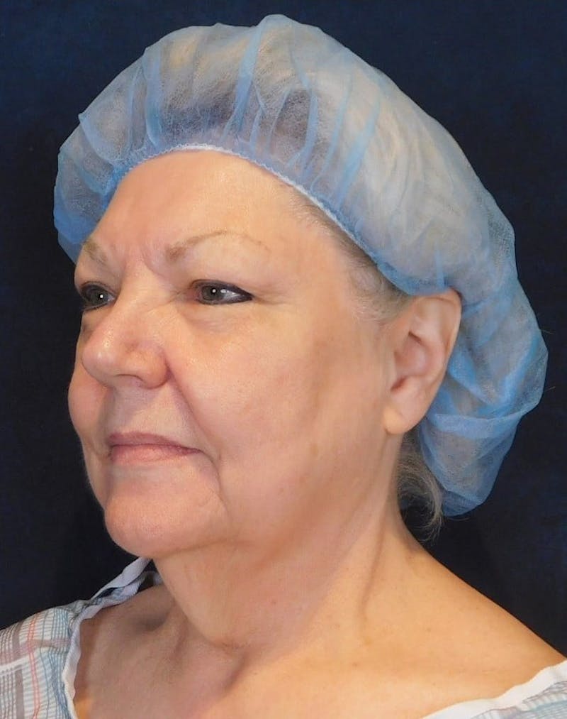Facelift & Neck Lift Before & After Gallery - Patient 312535 - Image 3