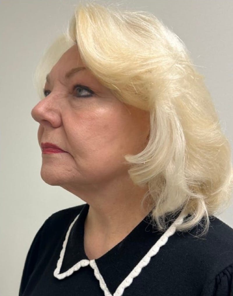 Facelift & Neck Lift Before & After Gallery - Patient 312535 - Image 4