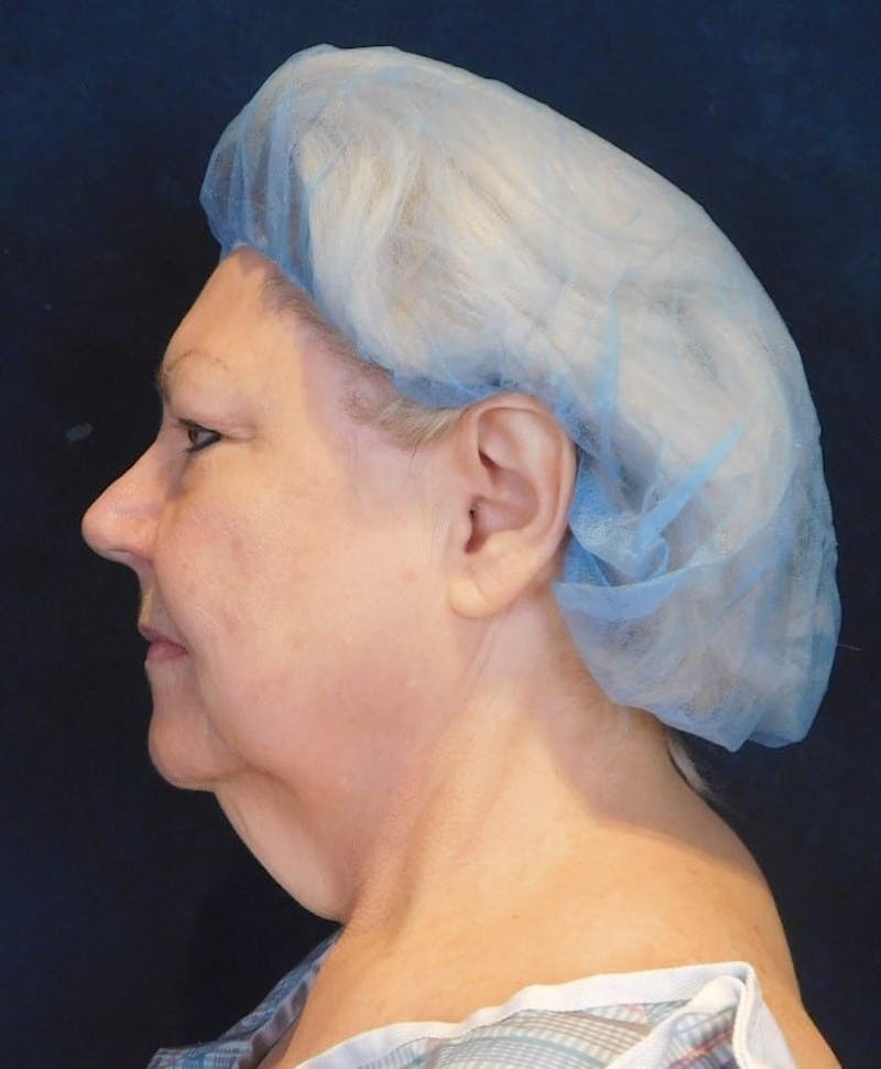 Facelift & Neck Lift Before & After Gallery - Patient 312535 - Image 5