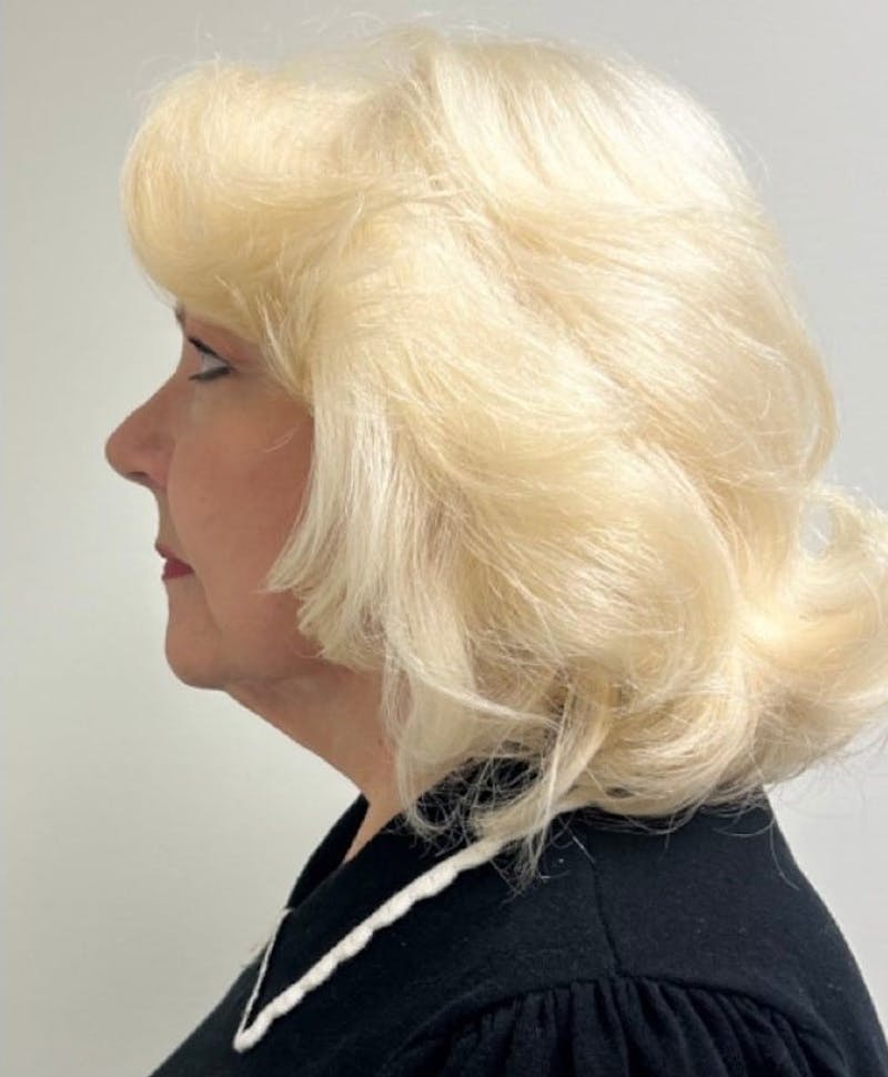 Facelift & Neck Lift Before & After Gallery - Patient 312535 - Image 6
