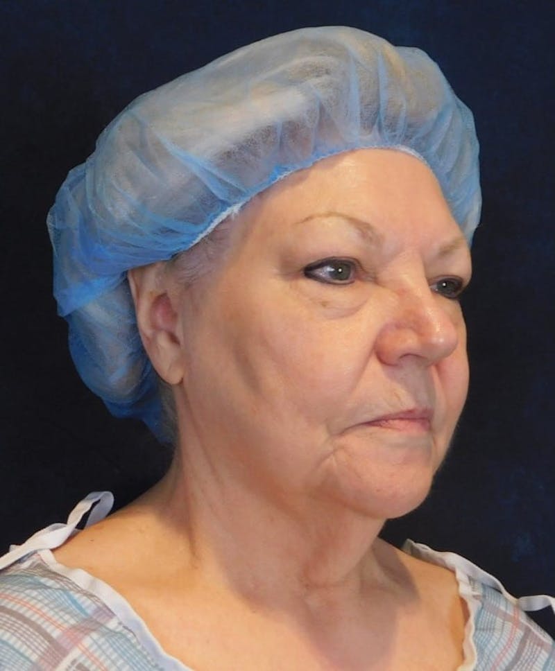 Facelift & Neck Lift Before & After Gallery - Patient 312535 - Image 7