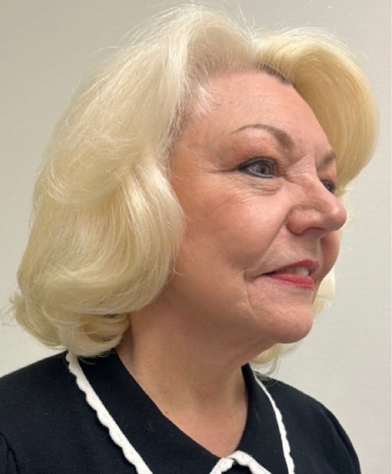 Facelift & Neck Lift Before & After Gallery - Patient 312535 - Image 8