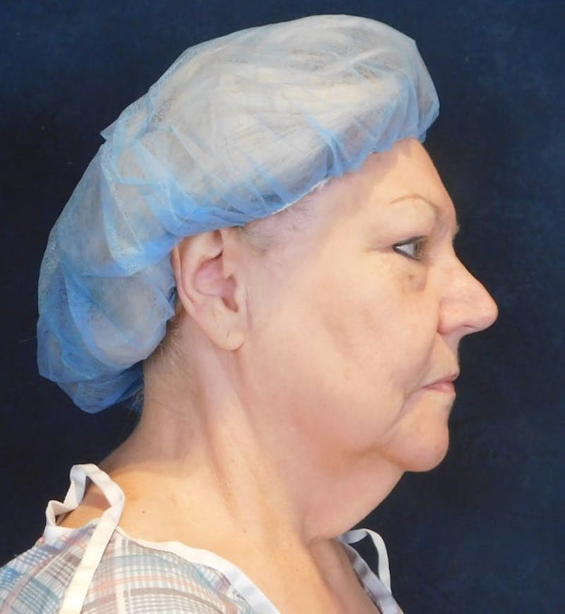 Facelift & Neck Lift Before & After Gallery - Patient 312535 - Image 9