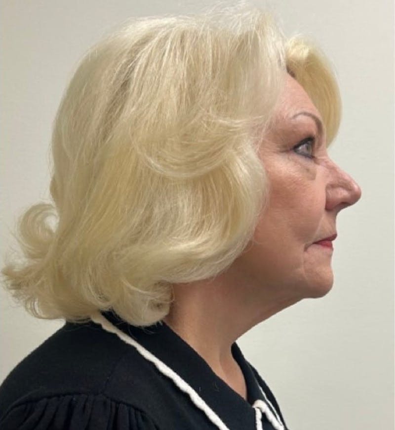 Facelift & Neck Lift Before & After Gallery - Patient 312535 - Image 10