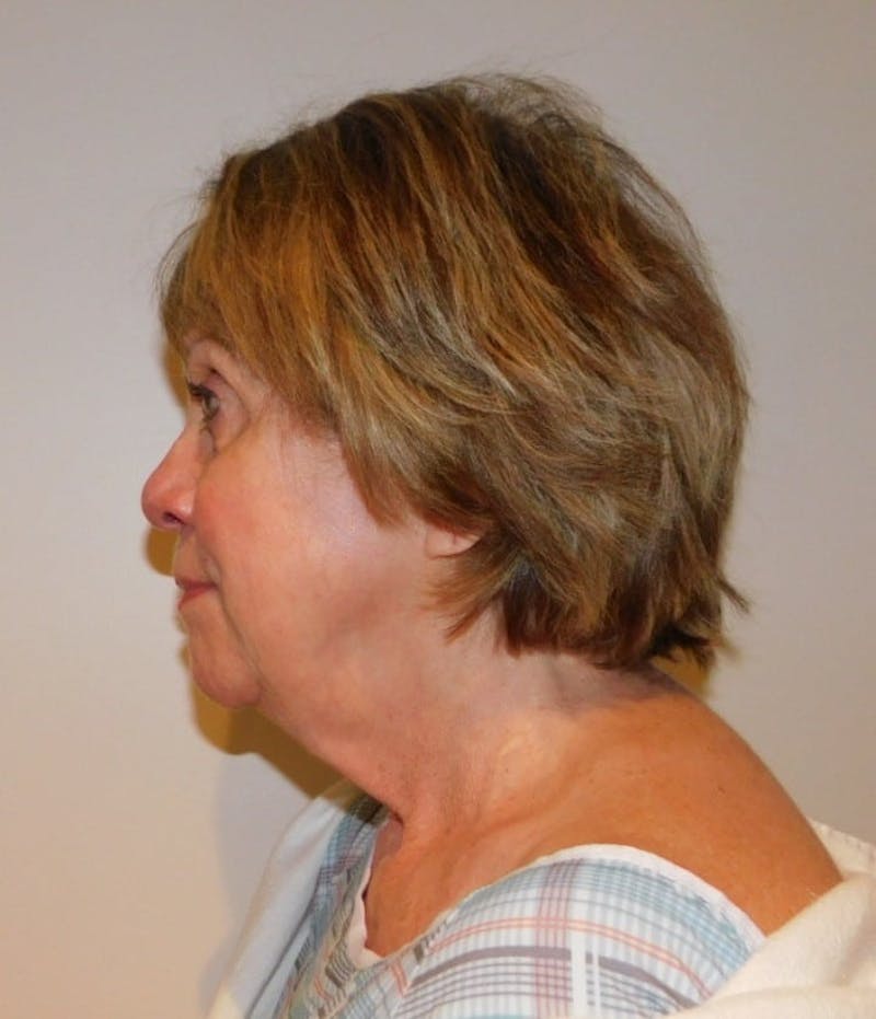 Facelift & Neck Lift Before & After Gallery - Patient 457511 - Image 1