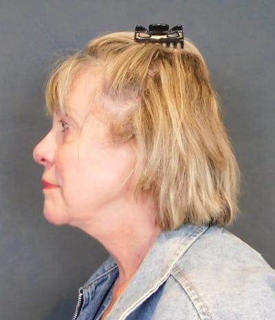 Facelift & Neck Lift Before & After Gallery - Patient 457511 - Image 2