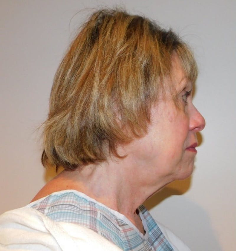 Facelift & Neck Lift Before & After Gallery - Patient 457511 - Image 3