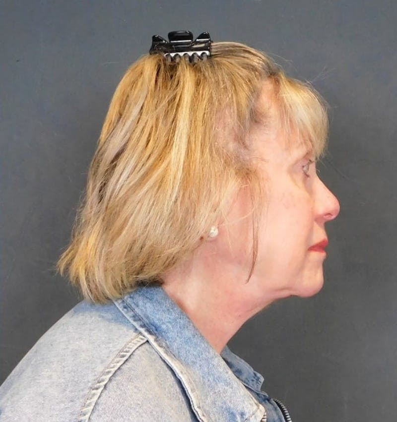 Facelift & Neck Lift Before & After Gallery - Patient 457511 - Image 4