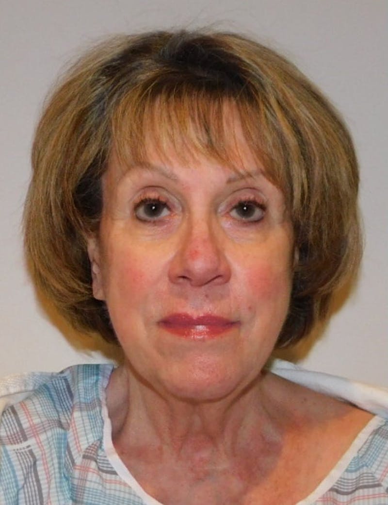 Facelift & Neck Lift Before & After Gallery - Patient 457511 - Image 5
