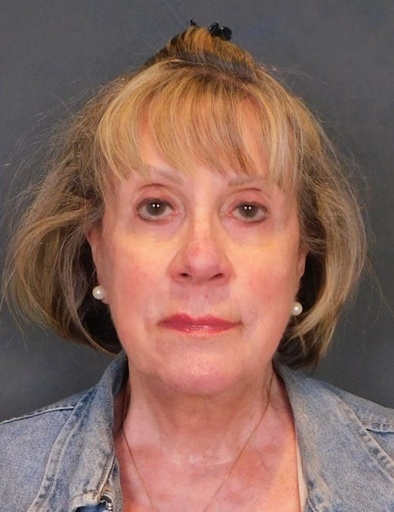 Facelift & Neck Lift Before & After Gallery - Patient 457511 - Image 6