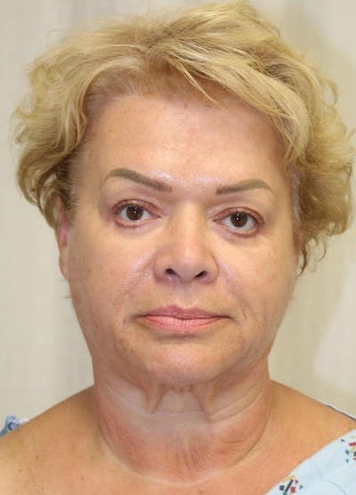 Facelift & Neck Lift Before & After Gallery - Patient 271362 - Image 1