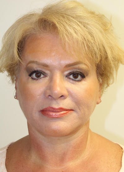 Facelift & Neck Lift Before & After Gallery - Patient 271362 - Image 2