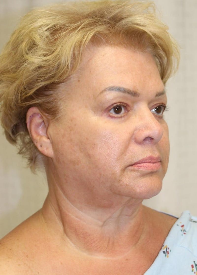 Facelift & Neck Lift Before & After Gallery - Patient 271362 - Image 3