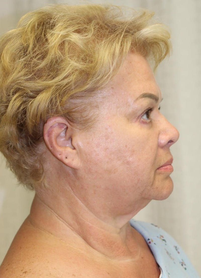 Facelift & Neck Lift Before & After Gallery - Patient 271362 - Image 5