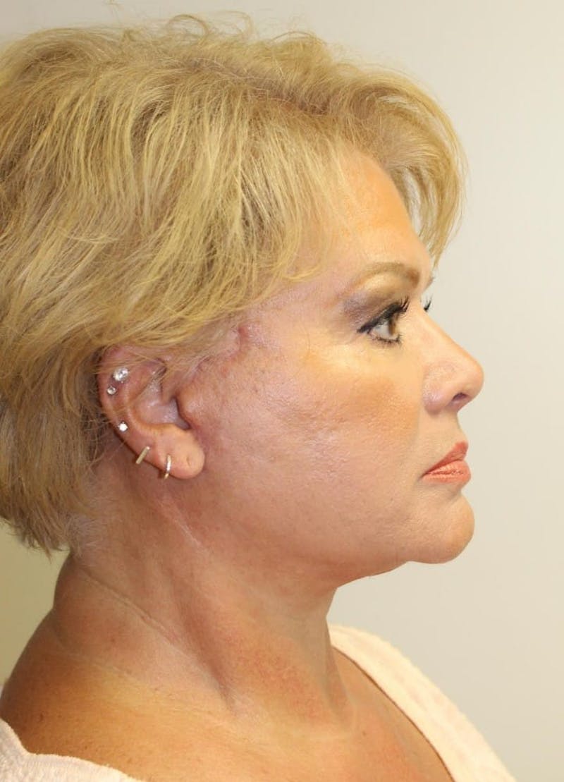 Facelift & Neck Lift Before & After Gallery - Patient 271362 - Image 6