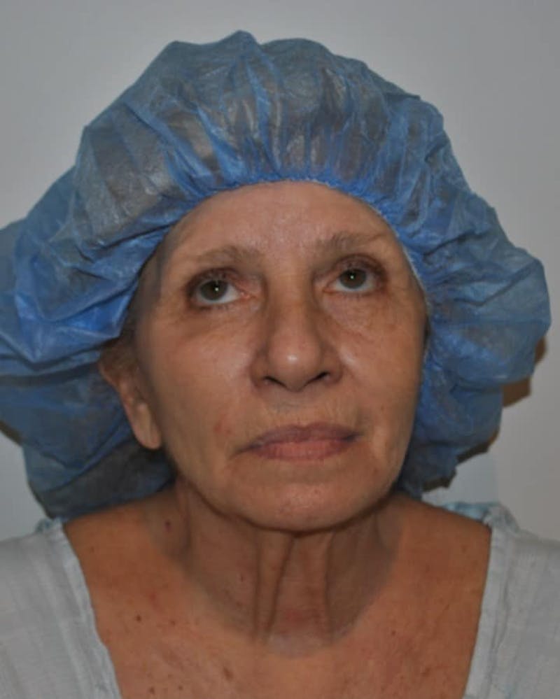 Facelift & Neck Lift Before & After Gallery - Patient 414325 - Image 1