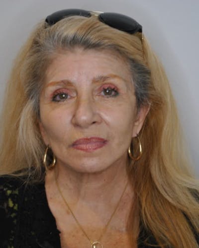 Facelift & Neck Lift Before & After Gallery - Patient 414325 - Image 2