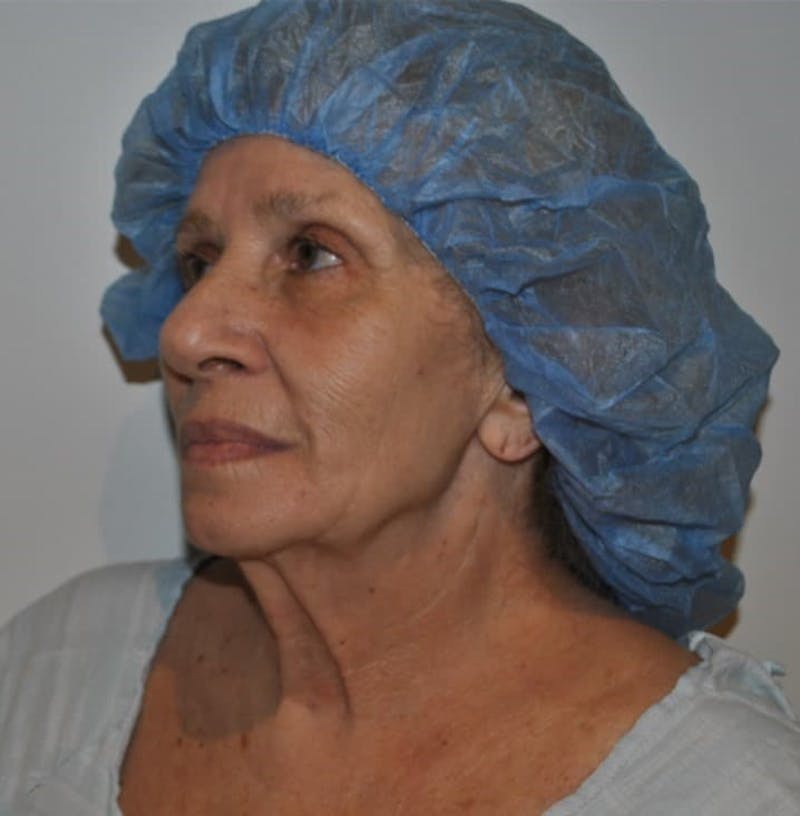 Facelift & Neck Lift Before & After Gallery - Patient 414325 - Image 3
