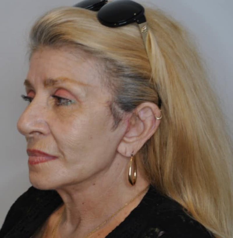Facelift & Neck Lift Before & After Gallery - Patient 414325 - Image 4