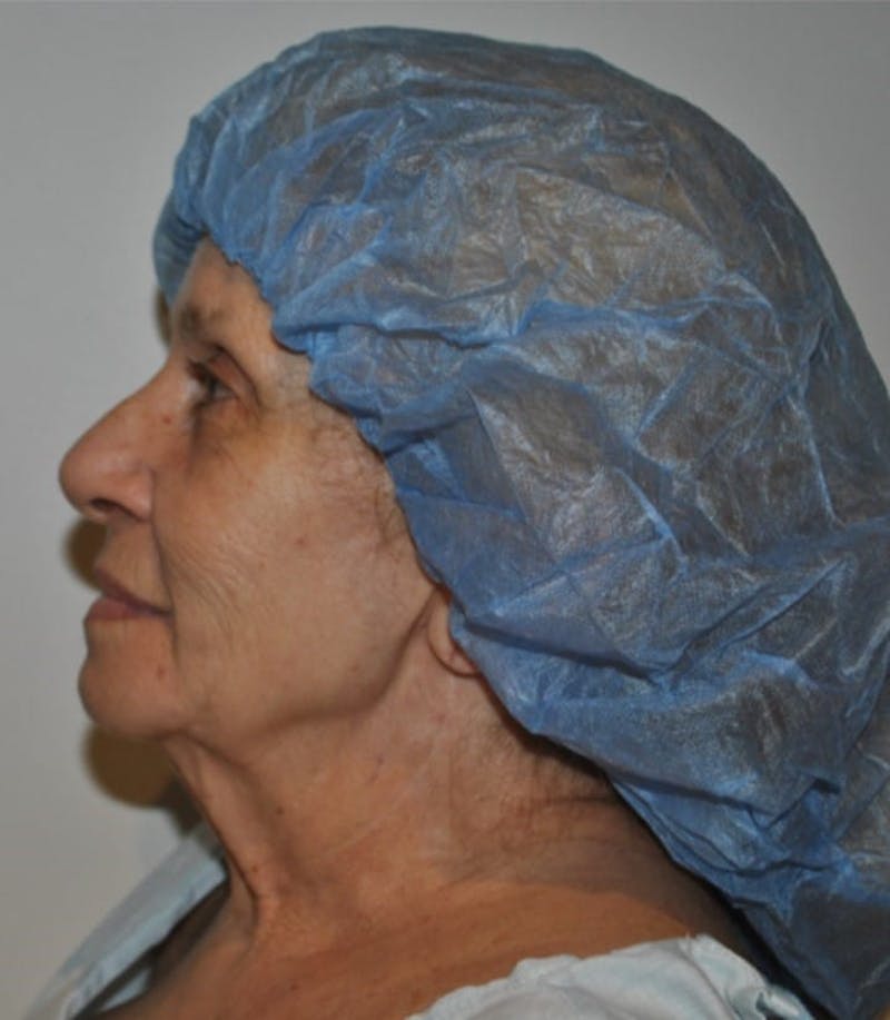 Facelift & Neck Lift Before & After Gallery - Patient 414325 - Image 5
