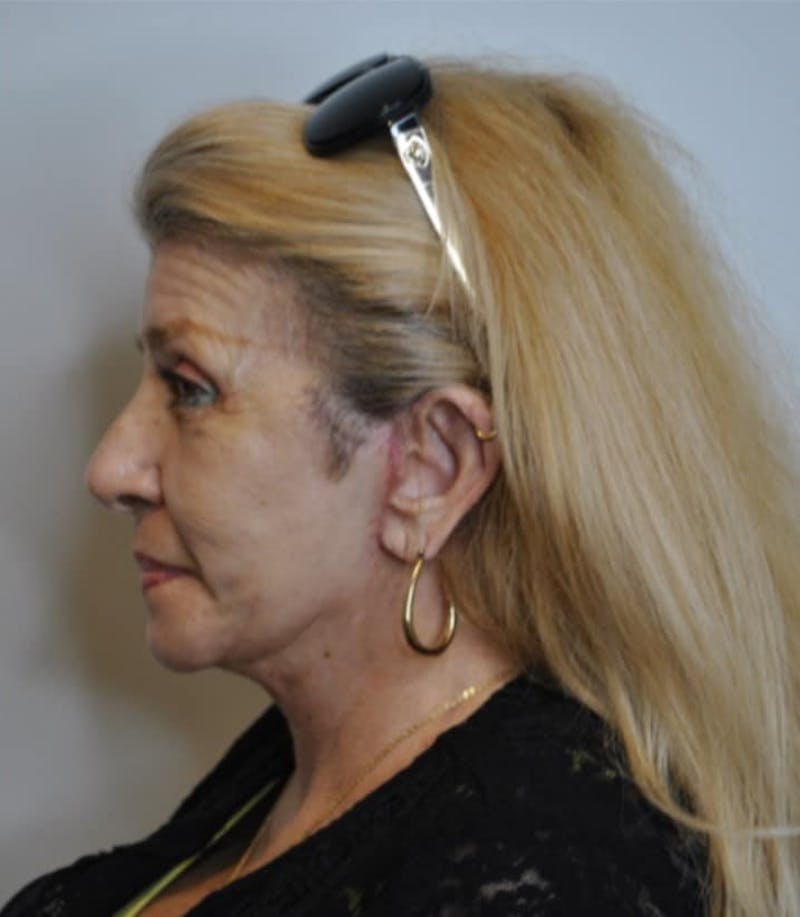 Facelift & Neck Lift Before & After Gallery - Patient 414325 - Image 6