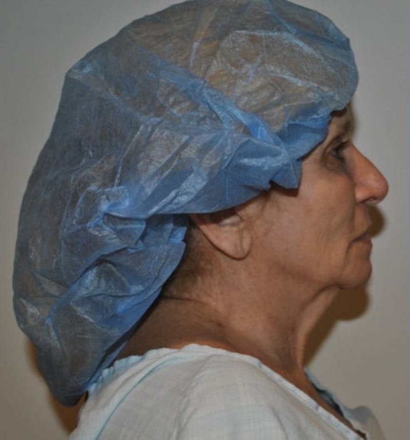 Facelift & Neck Lift Before & After Gallery - Patient 414325 - Image 7