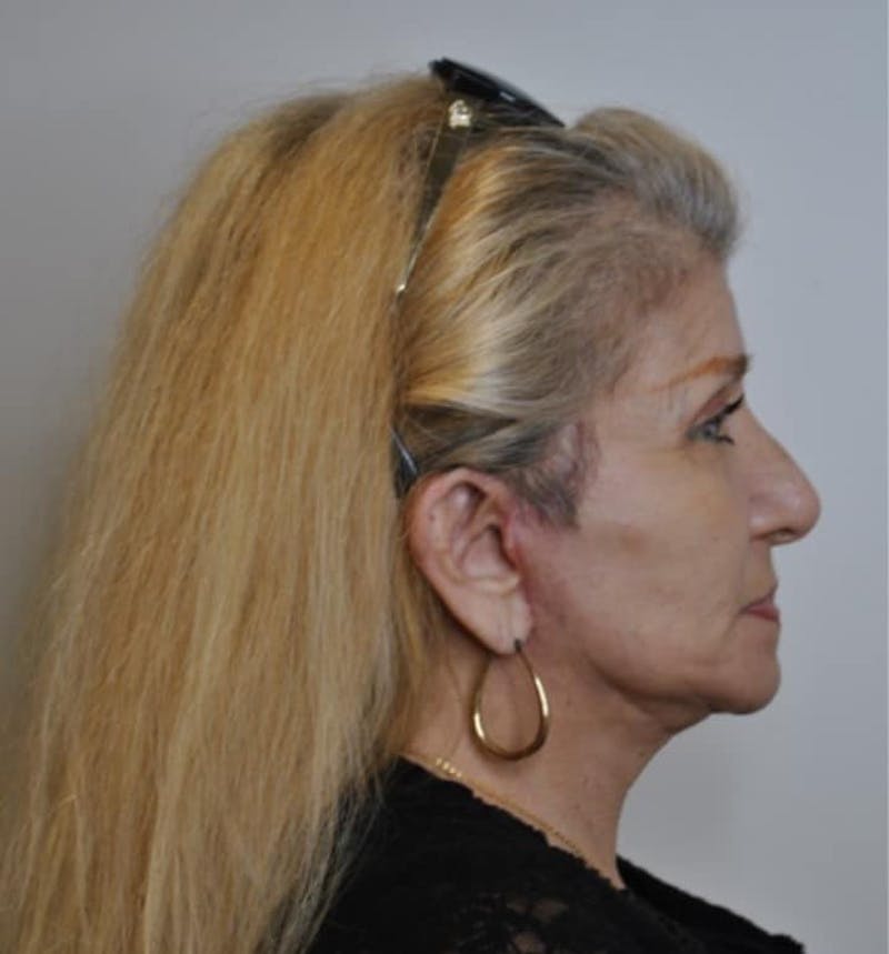 Facelift & Neck Lift Before & After Gallery - Patient 414325 - Image 8