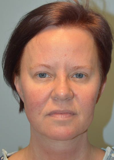 Facelift & Neck Lift Before & After Gallery - Patient 366636 - Image 1
