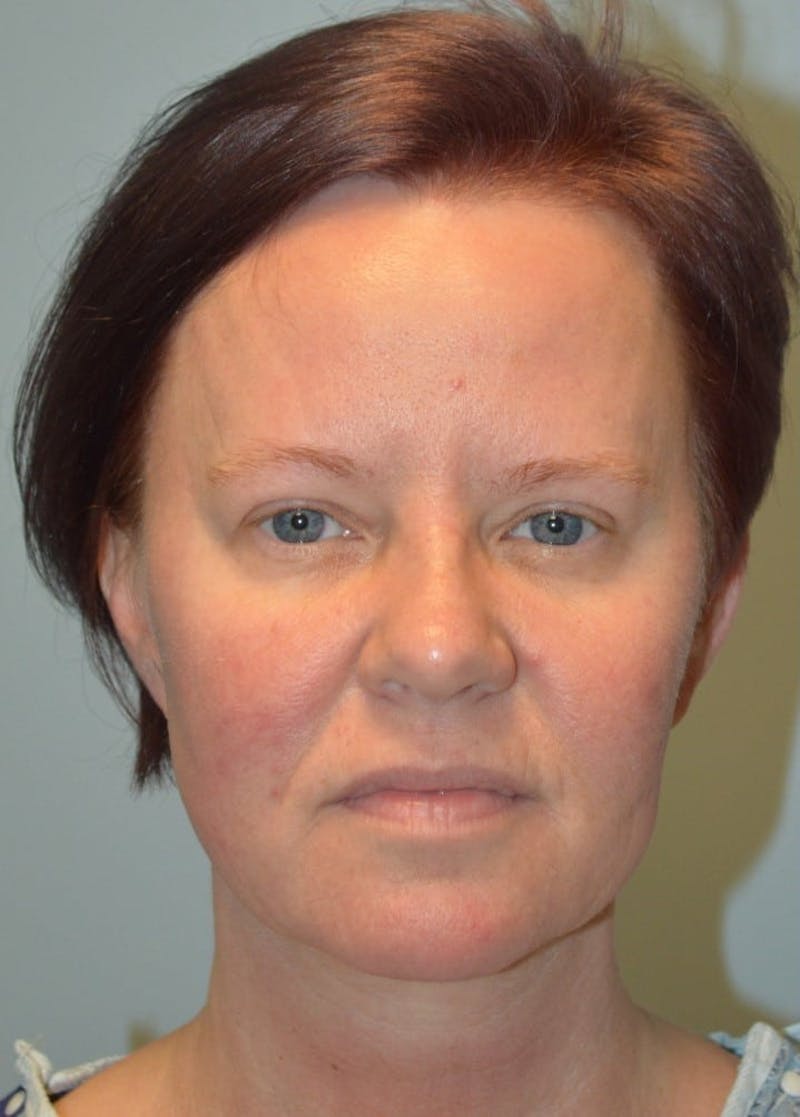 Facelift & Neck Lift Before & After Gallery - Patient 366636 - Image 1