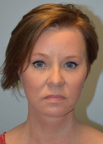 Facelift & Neck Lift Before & After Gallery - Patient 366636 - Image 2