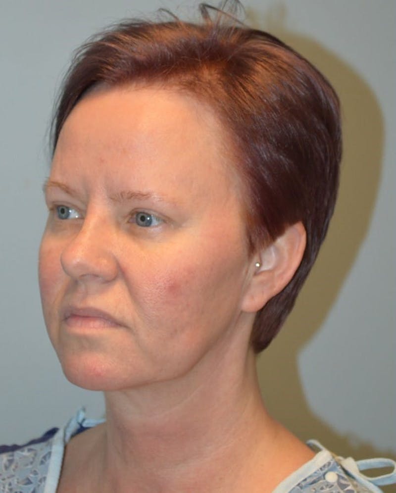 Facelift & Neck Lift Before & After Gallery - Patient 366636 - Image 3