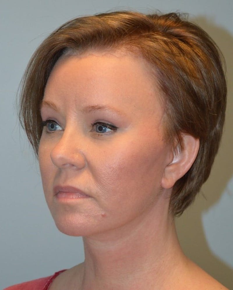 Facelift & Neck Lift Before & After Gallery - Patient 366636 - Image 4