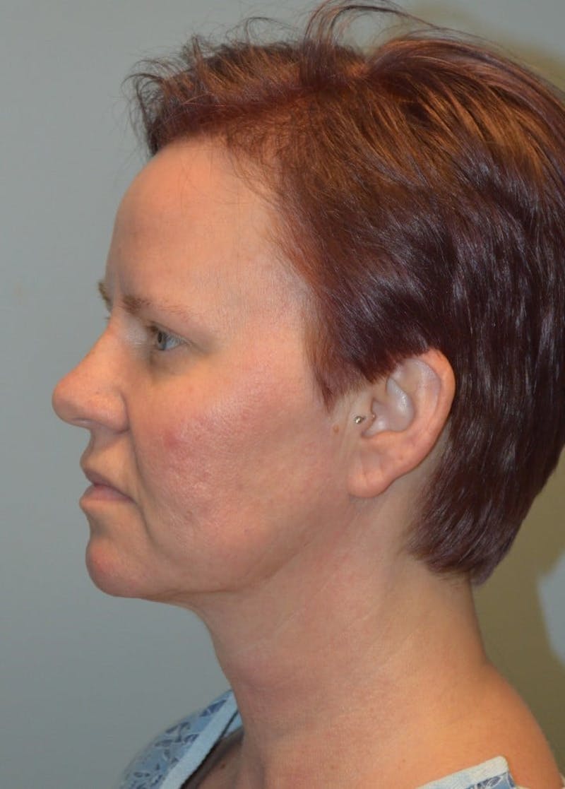Facelift & Neck Lift Before & After Gallery - Patient 366636 - Image 5