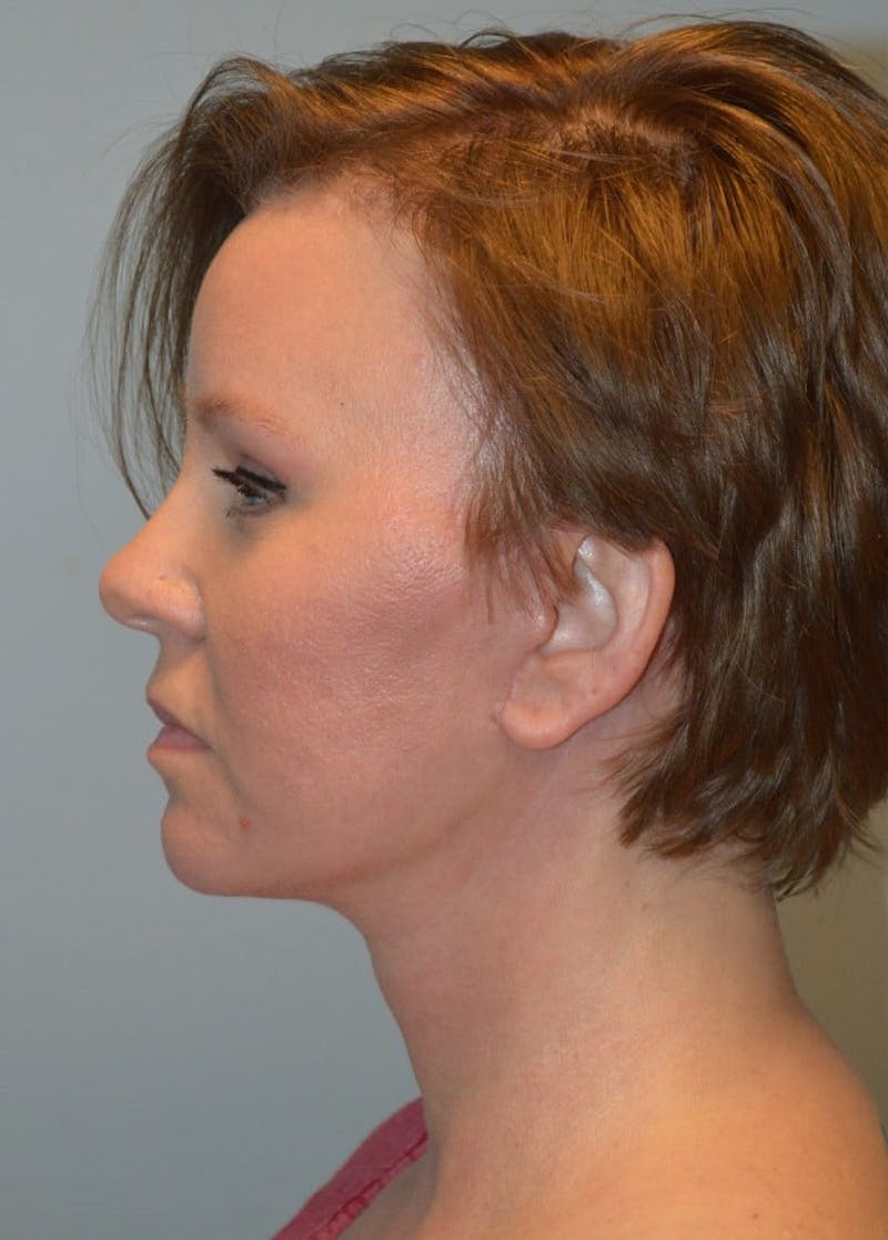 Facelift & Neck Lift Before & After Gallery - Patient 366636 - Image 6