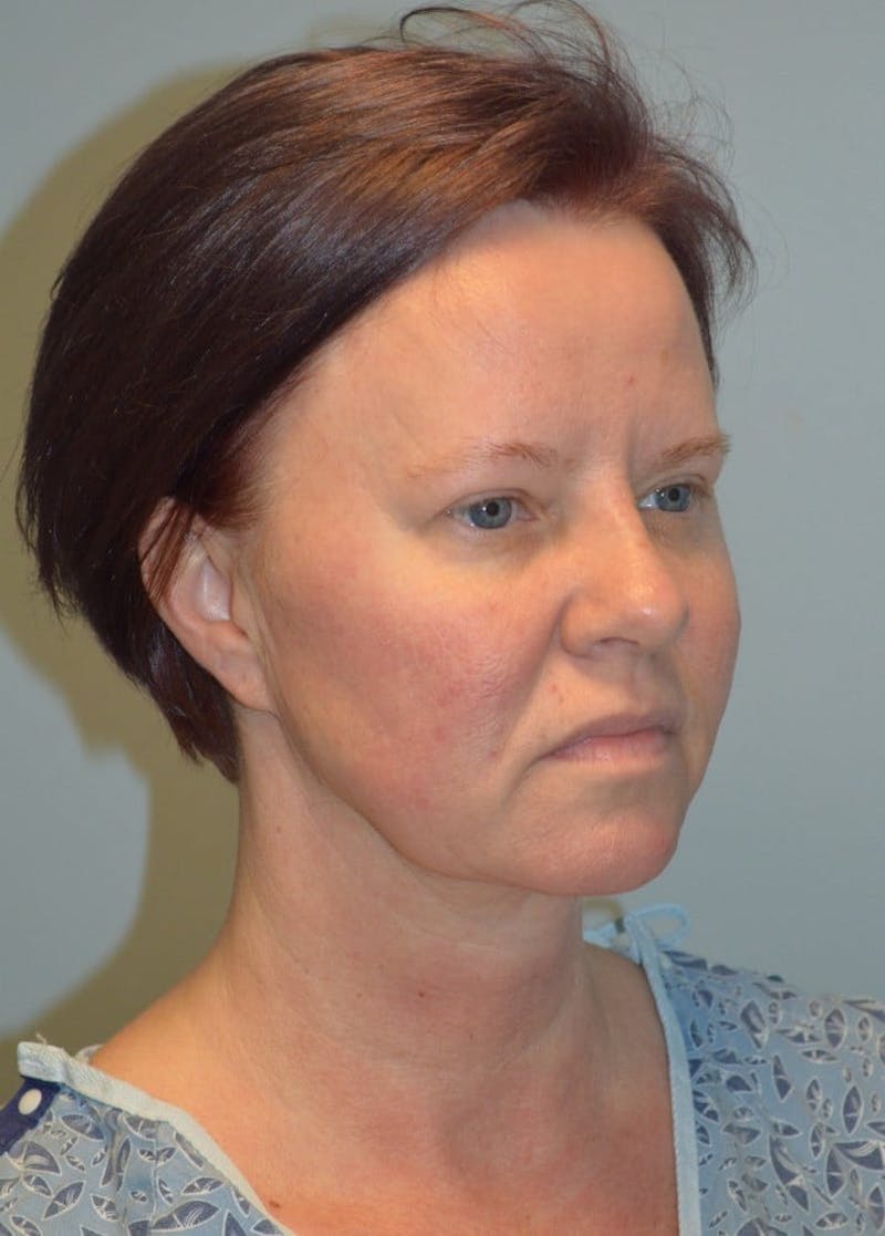 Facelift & Neck Lift Before & After Gallery - Patient 366636 - Image 7