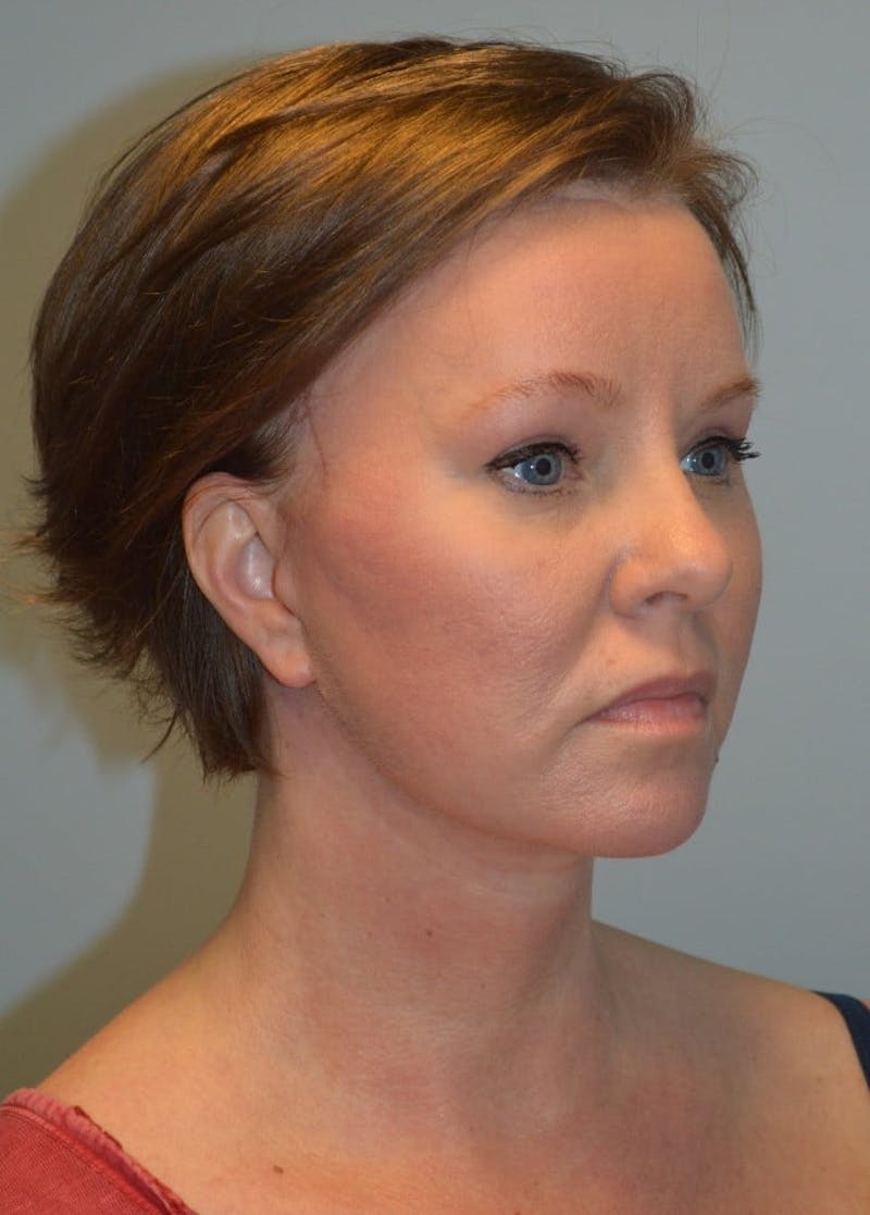 Facelift & Neck Lift Before & After Gallery - Patient 366636 - Image 8