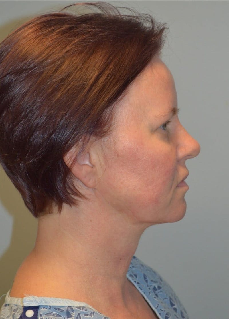 Facelift & Neck Lift Before & After Gallery - Patient 366636 - Image 9