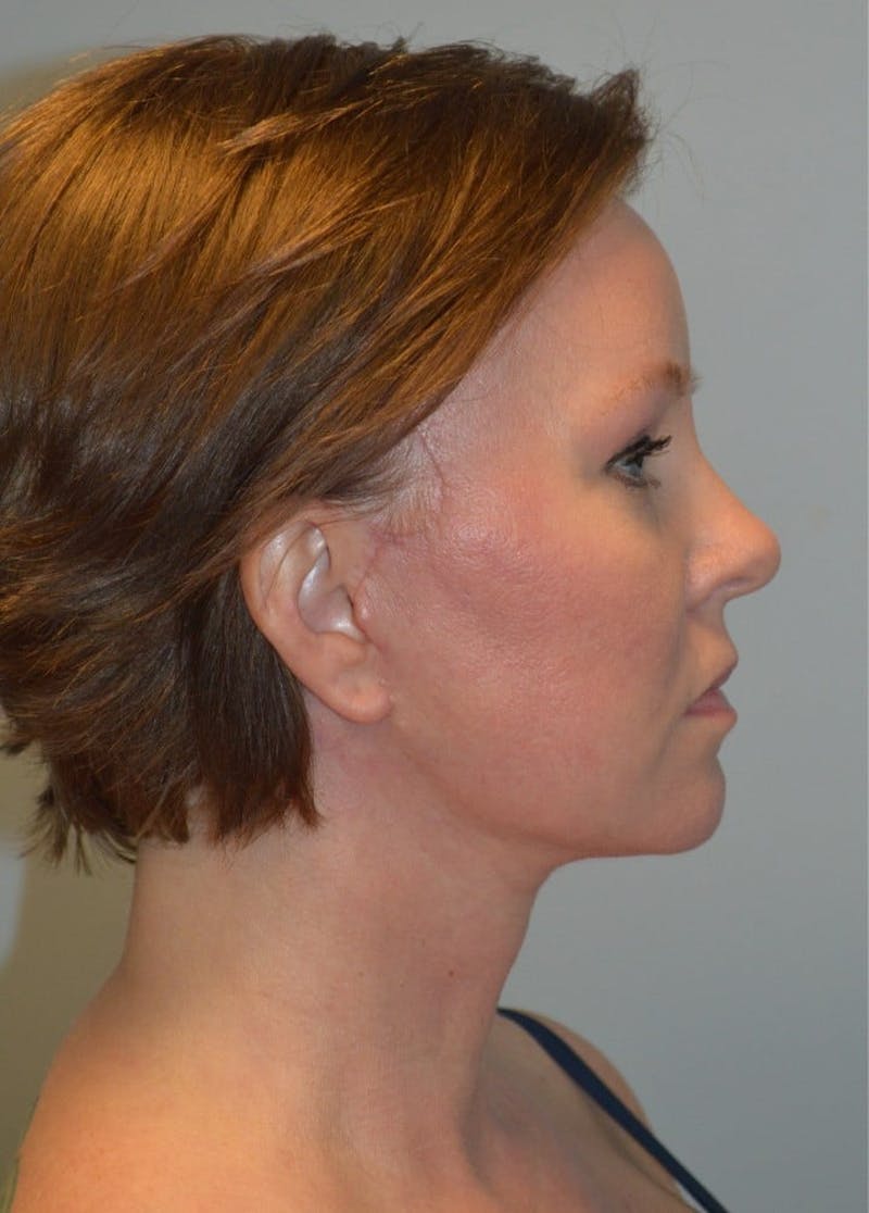 Facelift & Neck Lift Before & After Gallery - Patient 366636 - Image 10