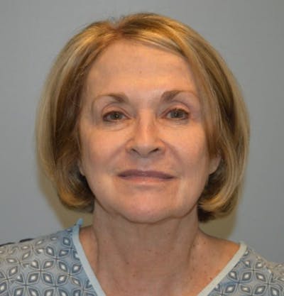 Surgical Lip Lift Before & After Gallery - Patient 922089 - Image 1