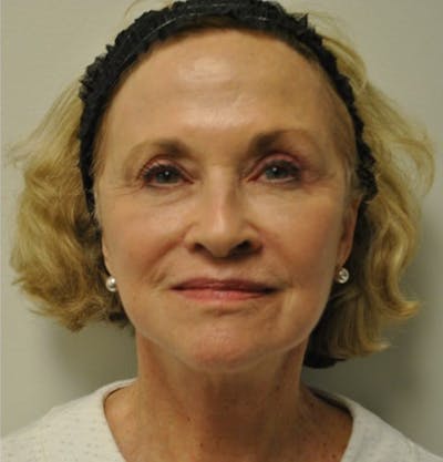 Surgical Lip Lift Before & After Gallery - Patient 922089 - Image 2