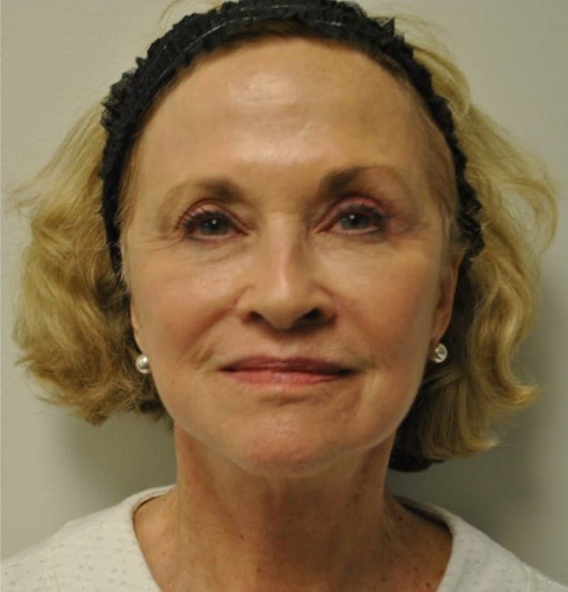 Surgical Lip Lift Before & After Gallery - Patient 922089 - Image 2